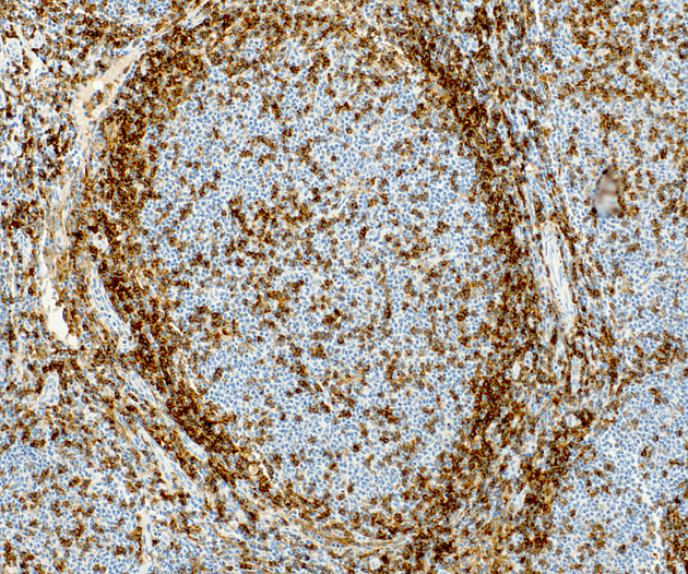 Když nádorové buňky získají výhodu. Český objev může pomoct s léčbou rakoviny uzlin